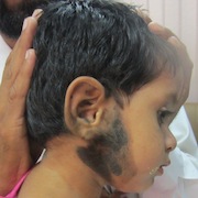 child with birth mark, congenital melanocytic nevus